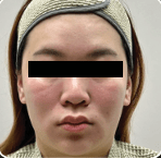 XTHERMA Before Case 01