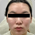 XTHERMA After Case 01