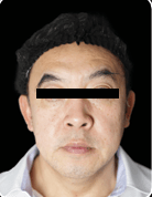 XTHERMA Before Case 02