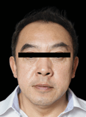 XTHERMA After Case 02